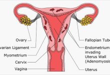 Adenomyosis Symptoms Diagnosis Causes and Treatments