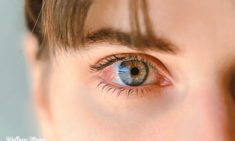 Home Remedies For Pink Eye 1 home remedies for pink eye