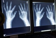 Rheumatoid Arthritis Diagnosis Everyday Health