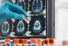 What Are the Latest Trends in Multiple Sclerosis Treatment