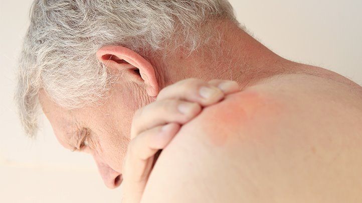 a man with eczema on his shoulder