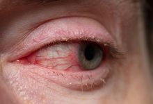 FDA Approves Xdemvy for Demodex Blepharitis Treatment