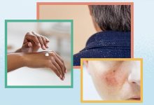 HIV Rash and More Skin Conditions Linked to HIV and