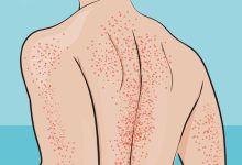 Symptoms of Immune Thrombocytopenia Everyday Health