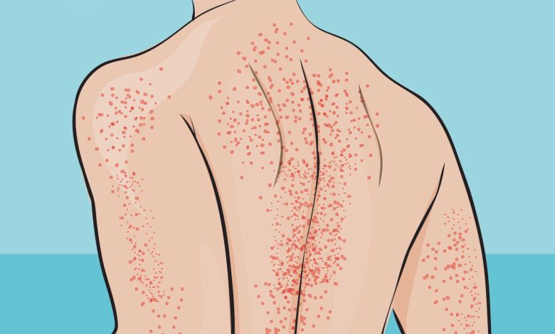 Signs of Immune Thrombocytopenia | On a regular basis Health 1 Symptoms of Immune Thrombocytopenia Everyday Health