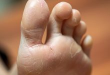 Tips for Managing Foot Psoriasis