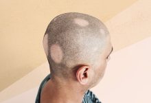 What Are the Different Types of Alopecia Areata