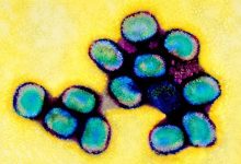 Eczema Atopic Dermatitis Complications