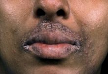 How to Treat Dark Patches and Light Spots From Atopic