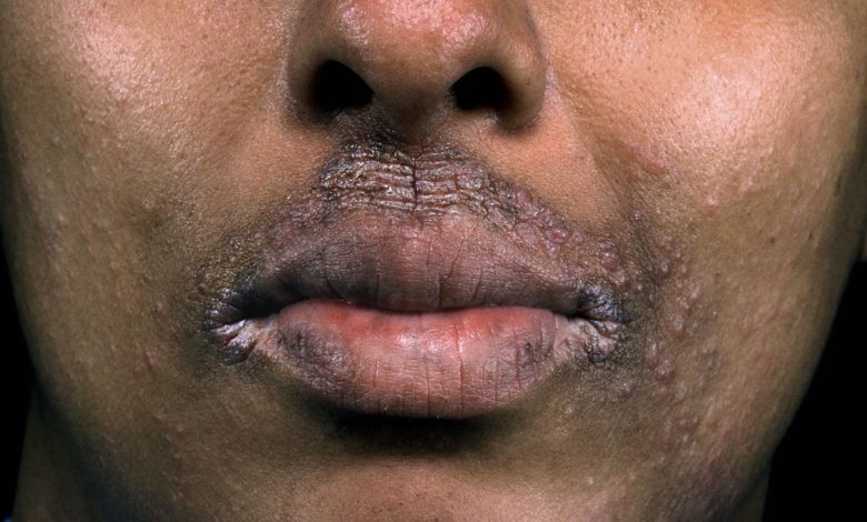 Easy methods to Deal with Darkish Patches and Mild Spots From Atopic Dermatitis 1 How to Treat Dark Patches and Light Spots From Atopic