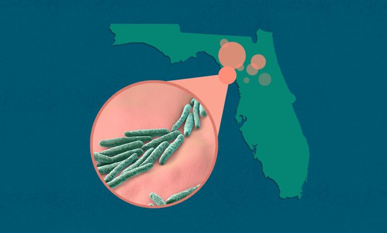 Leprosy Instances on the Rise in Florida, In keeping with CDC Report 1 Leprosy Cases on the Rise in Florida According to CDC