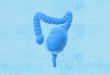 Toxic Megacolon Causes Symptoms and Treatment
