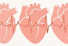 A Nasal Spray for Rapid Heartbeat Disorder Could Be Best