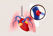 The Truth About Traveling Blood Clots