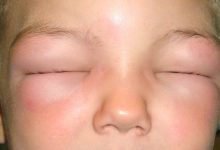 What Hereditary Angioedema Attacks Look Like on the Body Pictures