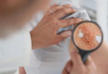 Atopic Dermatitis Skin Infections