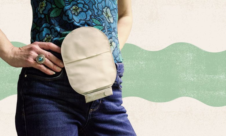 Coming to Phrases With a Stoma: Fears, Issues, and Help 1 Coming to Terms With a Stoma Fears Concerns and Support