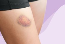 Hepatitis C Skin Conditions