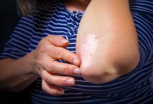 Psoriasis Spotting and Scarring How to Cope