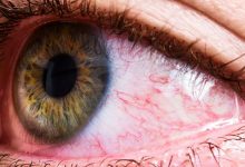 Puffy and Swollen Eyelid Treatment Home Remedies