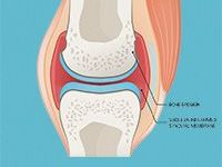 Rheumatoid Arthritis Disease Progression An Overview
