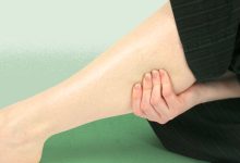 When Deep Vein Thrombosis Causes Long Term Damage