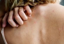 8 Common Types of Rashes
