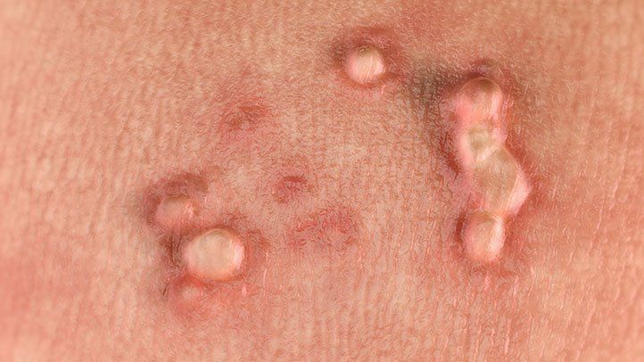 HPV Warts: The Misunderstood STD 1 HPV Warts The Misunderstood STD