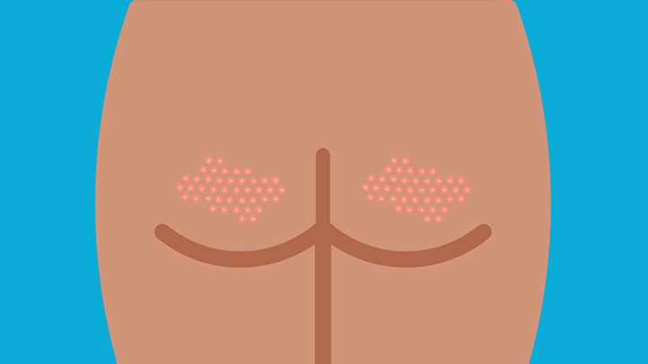 Get Rid of the Bumps on Your Behind 1 How to Get Rid of the Bumps on Your Behind