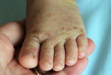 How to Know if That Rash Is Scabies