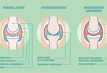 Rheumatoid Arthritis Joint Pain vs Osteoarthritis Joint Pain