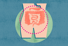 What Is Crohns Disease Symptoms Causes Diagnosis Treatment and Prevention