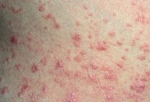 Causes Symptoms Treatments and Complications