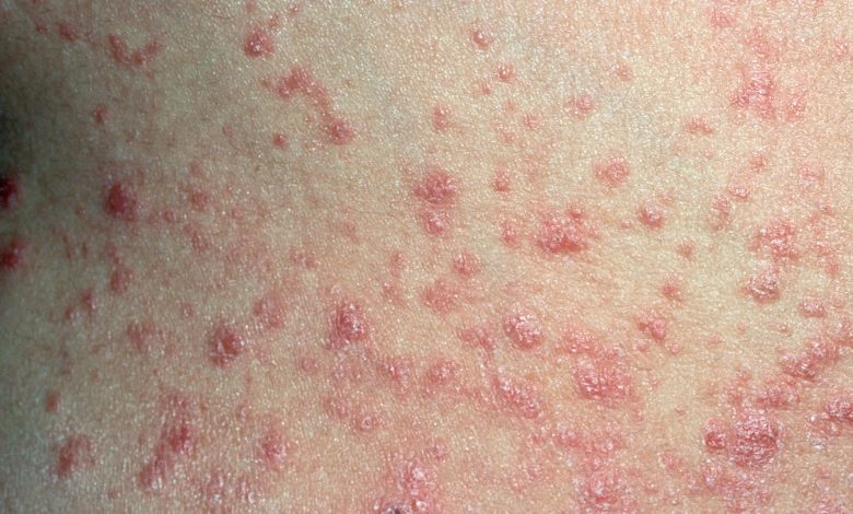 Causes, Signs, Therapies, and Issues 1 Causes Symptoms Treatments and Complications