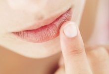 Chapped Lips Causes Treatments and Prevention