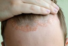 FDA Approves Foam to Treat Scalp Eczema in Children and