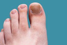 How to Stamp Out Toenail and Foot Fungus