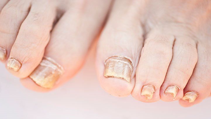 Is It Toenail Fungus or One thing Else? 1 Is It Toenail Fungus or Something Else